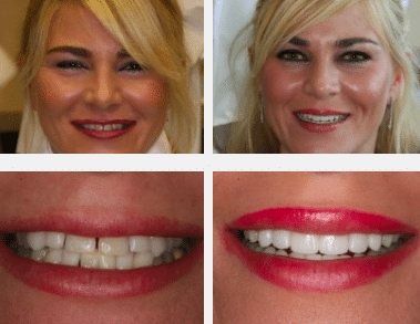 full mouth reconstruction before and after image patient 2