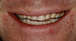 Worn teeth due to retractive orthodontics forcing grinding forward to open the airway, resulting seriously damaged teeth