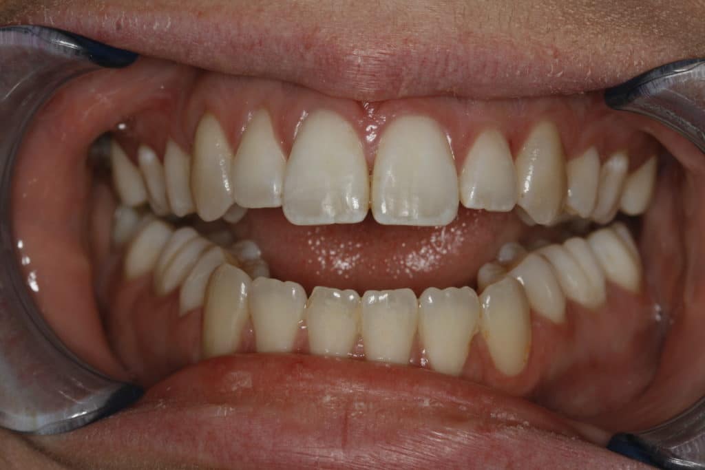 How Does My Bite Affect My TMJ and Airway? Dr. Konig