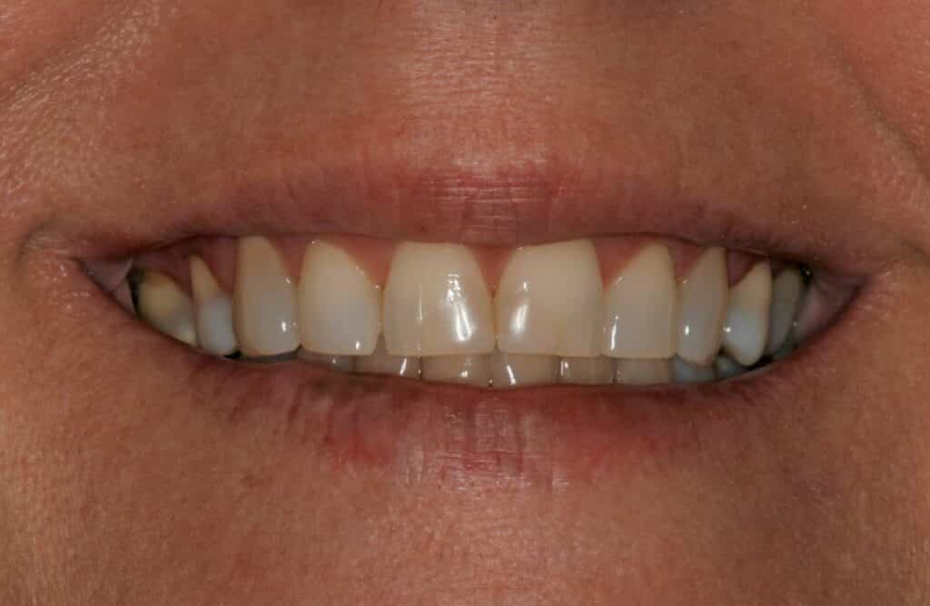 Can I Fix my Worn Teeth & Misaligned Bite?