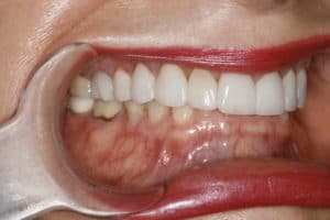 Overbite and worn teeth