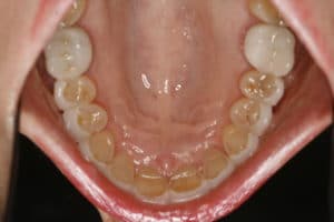 Occlusal view of upper teeth