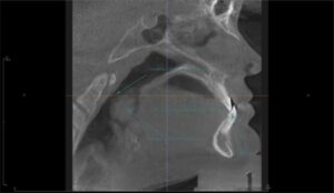 Tonsils blocking airway, causing underbite , poor posture, and sleep apnea