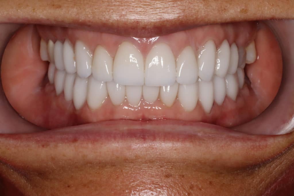 Improve the Shape of Your Face and TMJ Pain Relief with