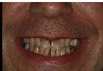 Can Porcelain Veneers Correct Spaces and Severely Stained Teeth?