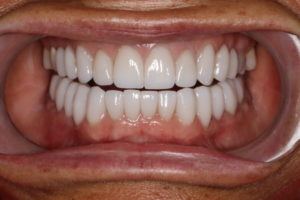 Custom porcelain veneers to correct bite and create a beautiful smile