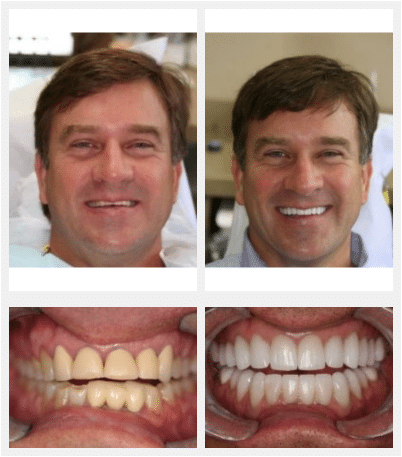 man’s face and teeth before and after TMJ treatment, teeth more aligned and chips in teeth fixed after treatment