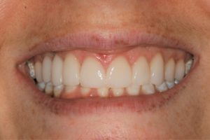 After: Gum lift and natural designed porcelain veneers