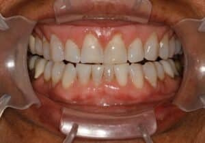 Before: worn and discolored teeth