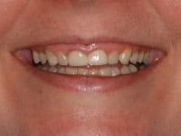 Before Image: Porcelain Veneers - other