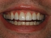 After Image: Porcelain Veneers - other