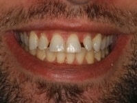 Before Image: Porcelain Veneers - other