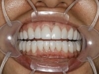 After Image: Porcelain Veneers - other