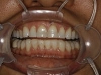 Before Image: Porcelain Veneers - other