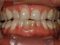 Before Image: Porcelain Veneers - other