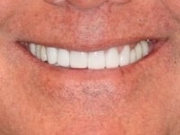 After Image: Porcelain Veneers - other