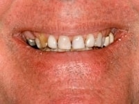 Before Image: Porcelain Veneers - other