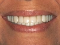 After Image: Porcelain Veneers - other