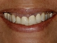Before Image: Porcelain Veneers - other