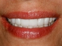 After Image: Porcelain Veneers - front