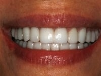 Before Image: Porcelain Veneers - front