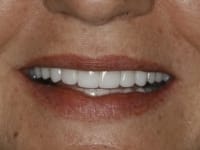 After Image: Porcelain Veneers - front