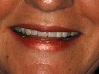 Before Image: Porcelain Veneers - front