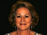 Before Image: Porcelain Veneers - front