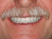 After Image: Porcelain Veneers - front