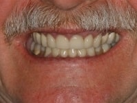 Before Image: Porcelain Veneers - front