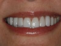 After Image: Porcelain Veneers - other