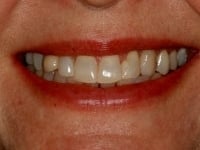 Before Image: Porcelain Veneers - other