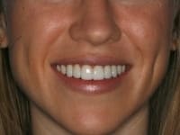 After Image: Porcelain Veneers - other