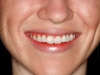 Before Image: Porcelain Veneers - other