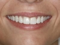After Image: Porcelain Veneers - other