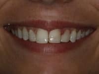 Before Image: Porcelain Veneers - other