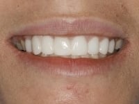 After Image: Porcelain Veneers - other