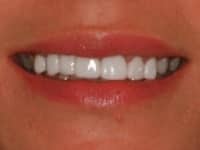 Before Image: Porcelain Veneers - other