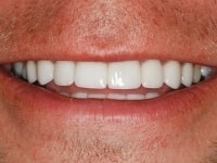 After Image: Porcelain Veneers - other