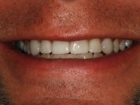 Before Image: Porcelain Veneers - other