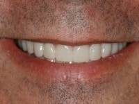 After Image: Porcelain Veneers - other