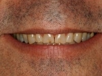 Before Image: Porcelain Veneers - other