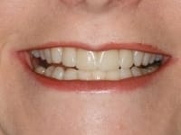 Front teeth after porcelain veneers procedure.