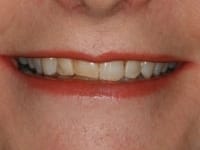 Chipped and worn front teeth before porcelain veneers procedure.