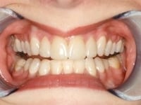 Teeth after custom shaded veneers procedure.