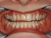Worn & chipped teeth before custom shaded veneers procedure.