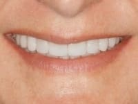 After Image: Porcelain Veneers - other