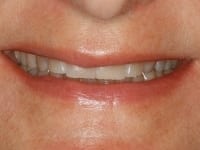 Before Image: Porcelain Veneers - other