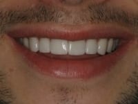 After Image: Porcelain Veneers - other