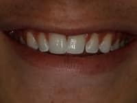 Before Image: Porcelain Veneers - other